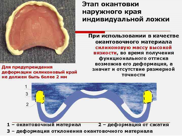 Припасовка индивидуальной ложки на верхней челюсти проводят по следующему плану