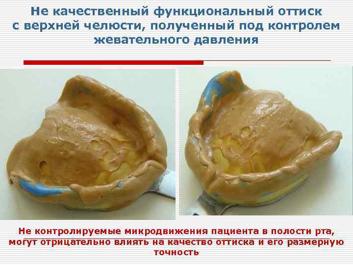Не качественный функциональный оттиск с верхней челюсти, полученный под контролем жевательного давления Не контролируемые