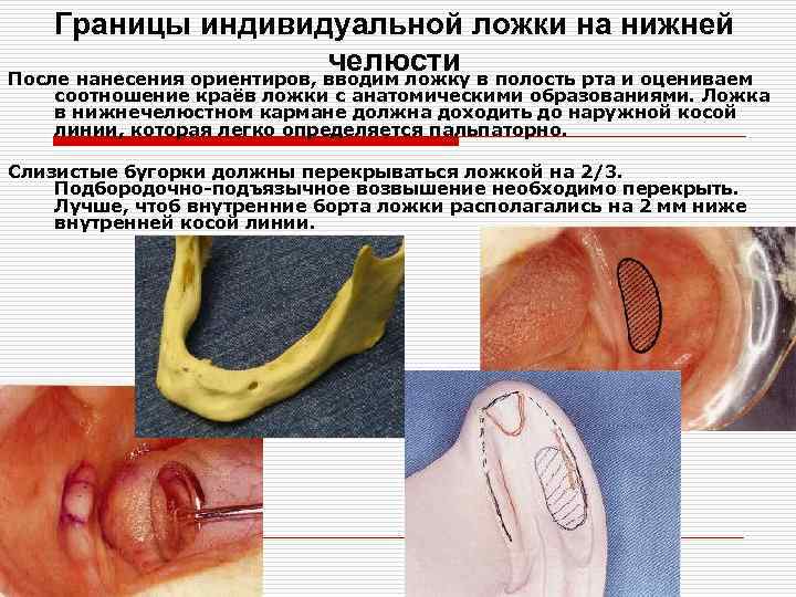 Границы индивидуальной ложки на нижней челюсти После нанесения ориентиров, вводим ложку в полость рта