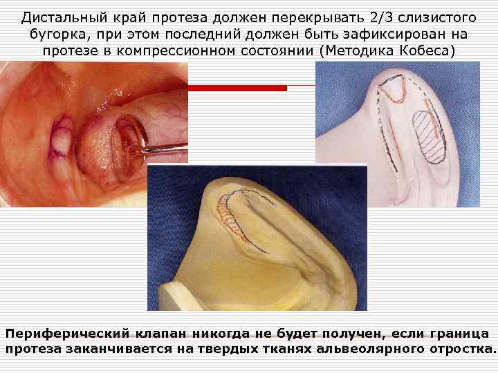 Дистальный край протеза должен перекрывать 2/3 слизистого бугорка, при этом последний должен быть зафиксирован