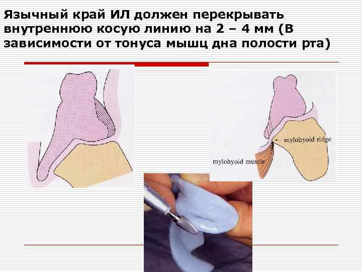 Язычный край ИЛ должен перекрывать внутреннюю косую линию на 2 – 4 мм (В