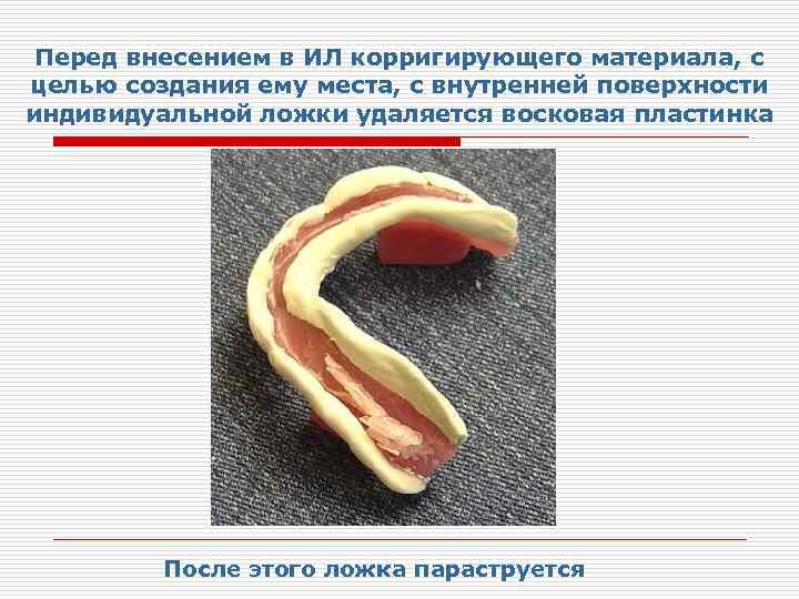Перед внесением в ИЛ корригирующего материала, с целью создания ему места, с внутренней поверхности