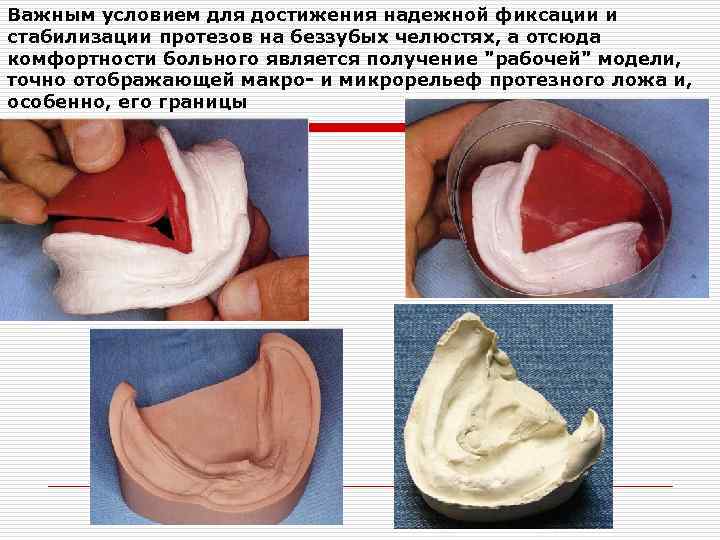 Протезное поле и протезное ложе. Индивидуальная ложка на беззубую челюсть. Модели беззубых челюстей. Индивидуальная ложка на нижнюю челюсть беззубую. Границы индивидуальной ложки.