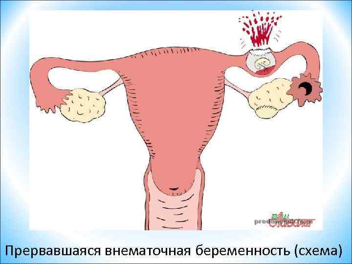 Прервавшаяся внематочная беременность (схема) 
