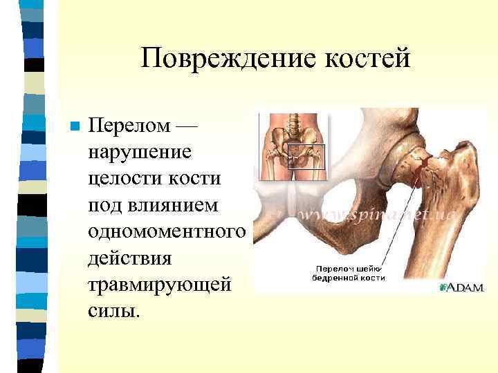 Повреждение костей n Перелом — нарушение целости кости под влиянием одномоментного действия травмирующей силы.