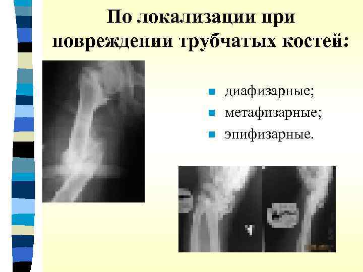 По локализации при повреждении трубчатых костей: n n диафизарные; метафизарные; эпифизарные. 