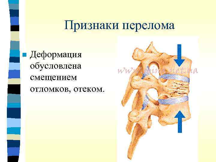 Признаки перелома n Деформация обусловлена смещением отломков, отеком. 