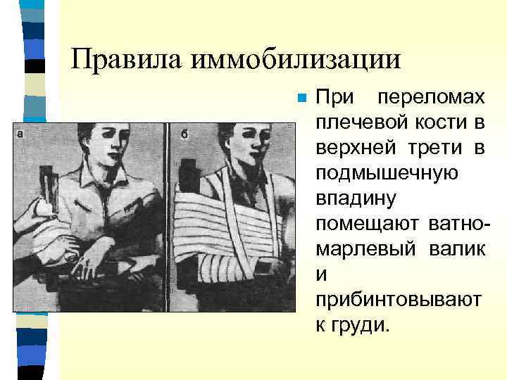 Правила иммобилизации n При переломах плечевой кости в верхней трети в подмышечную впадину помещают