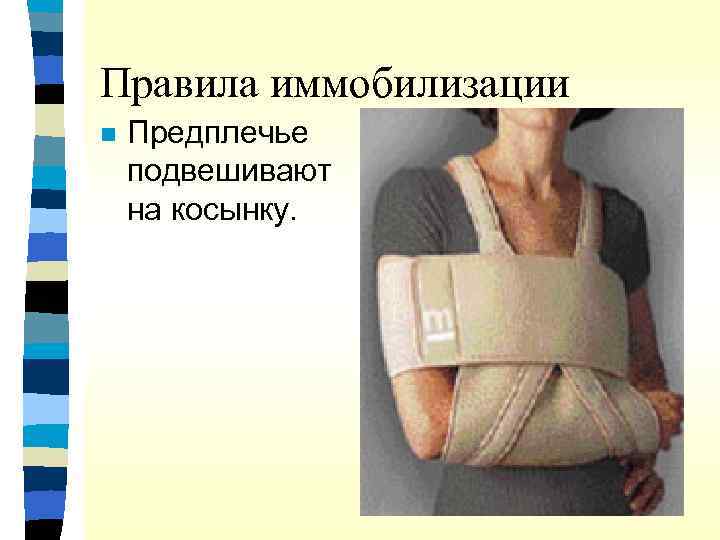 Правила иммобилизации n Предплечье подвешивают на косынку. 