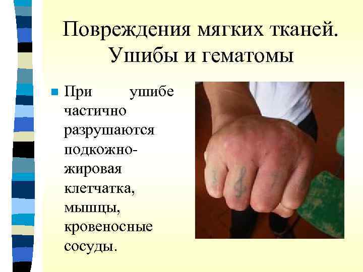 Повреждения мягких тканей. Ушибы и гематомы n При ушибе частично разрушаются подкожножировая клетчатка, мышцы,