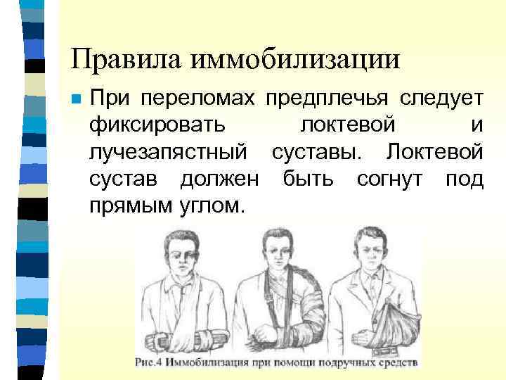 Правила иммобилизации n При переломах предплечья следует фиксировать локтевой и лучезапястный суставы. Локтевой сустав