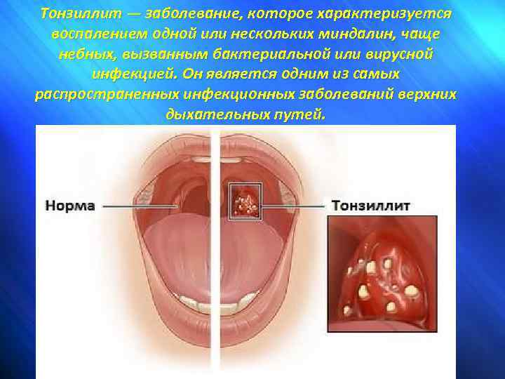 Тонзиллит — заболевание, которое характеризуется воспалением одной или нескольких миндалин, чаще небных, вызванным бактериальной