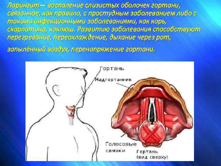 Ларингит— воспаление слизистых оболочек гортани, связанное, как правило, с простудным заболеванием либо с такими