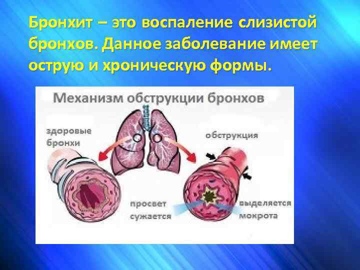 Бронхит – это воспаление слизистой бронхов. Данное заболевание имеет острую и хроническую формы. 