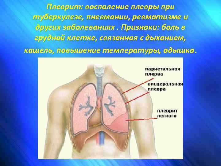 Плеврит: воспаление плевры при туберкулезе, пневмонии, ревматизме и других заболеваниях. Признаки: боль в грудной