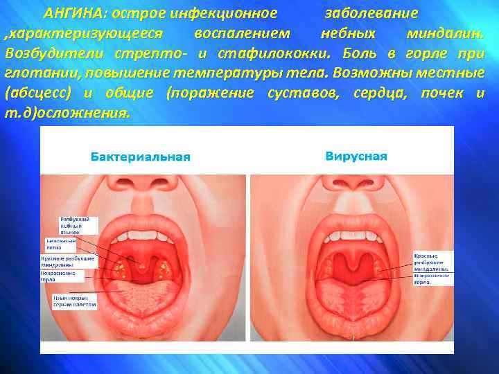 АНГИНА: острое инфекционное заболевание , характеризующееся воспалением небных миндалин. Возбудители стрепто- и стафилококки. Боль