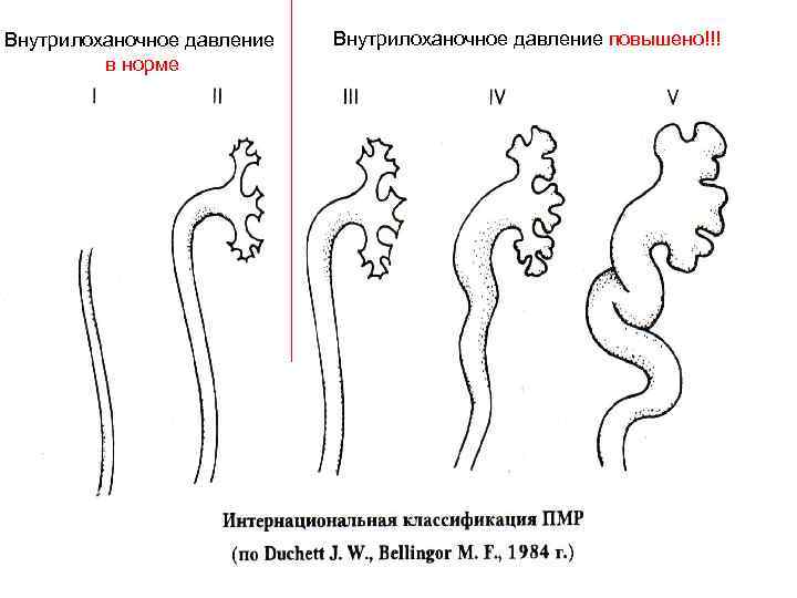 Внутрилоханочное давление в норме Внутрилоханочное давление повышено!!! 