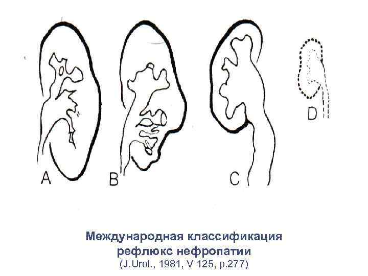 Международная классификация рефлюкс нефропатии (J. Urol. , 1981, V 125, p. 277) 