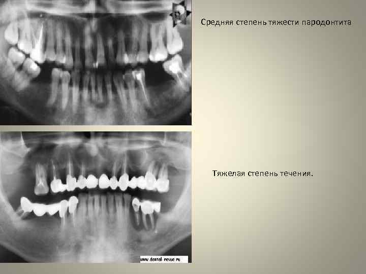 Средняя степень тяжести пародонтита Тяжелая степень течения. 