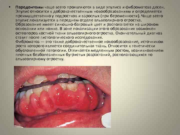 • Пародонтомы чаще всего проявляются в виде эпулиса и фиброматоза десен. Эпулис относится