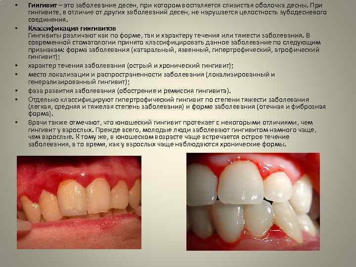  • • Гингивит – это заболевание десен, при котором воспаляется слизистая оболочка десны.