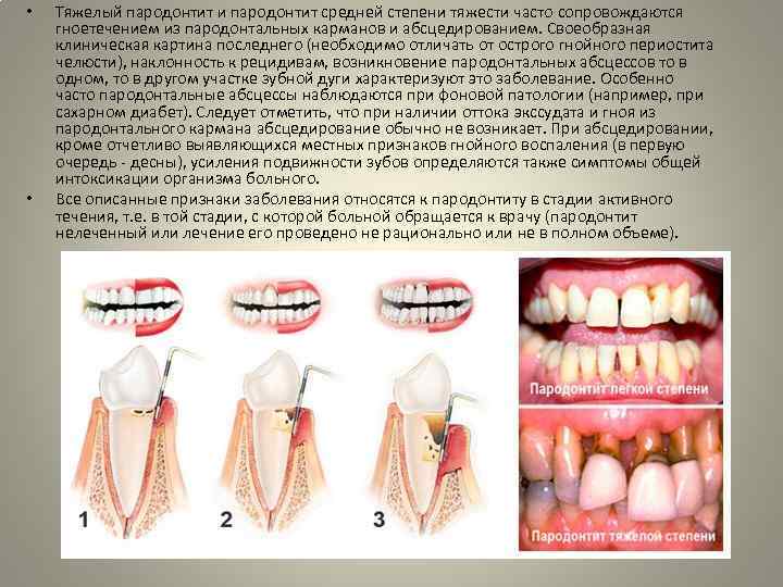 План лечения пародонтита