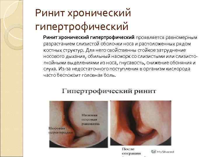 Ринит хронический гипертрофический проявляется равномерным разрастанием слизистой оболочки носа и расположенных рядом костных структур.