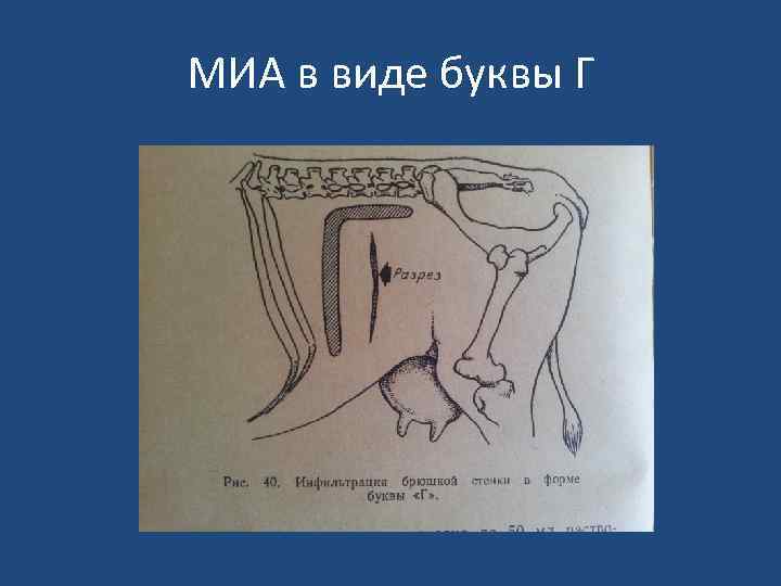 МИА в виде буквы Г 