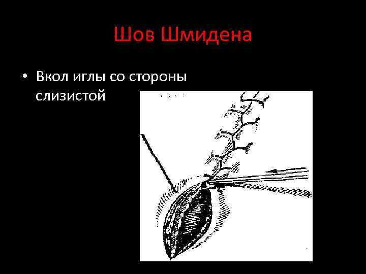 Шов Шмидена • Вкол иглы со стороны слизистой 