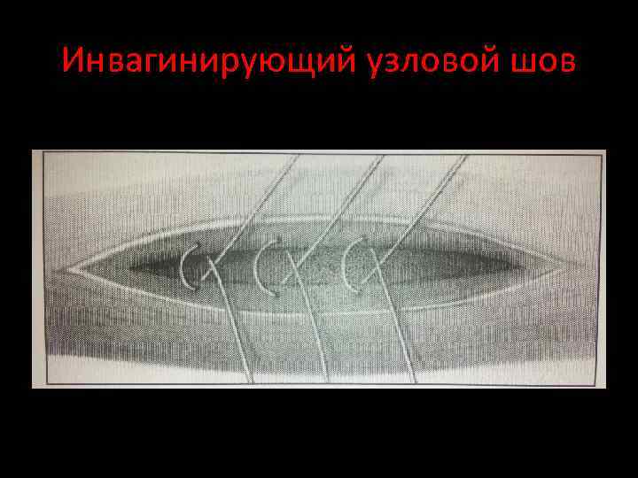 Инвагинирующий узловой шов 