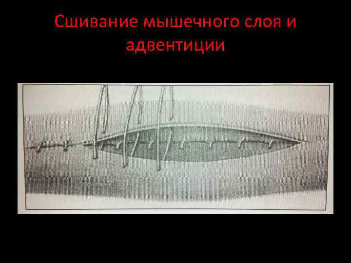 Сшивание мышечного слоя и адвентиции 