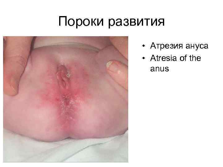 Пороки развития • Атрезия ануса • Atresia of the anus 