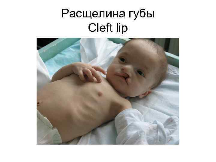 Расщелина губы Cleft lip 