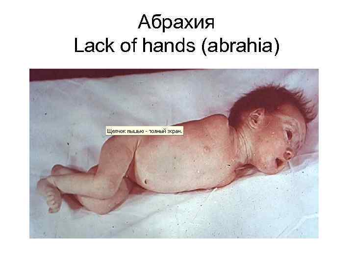 Абрахия Lack of hands (abrahia) 