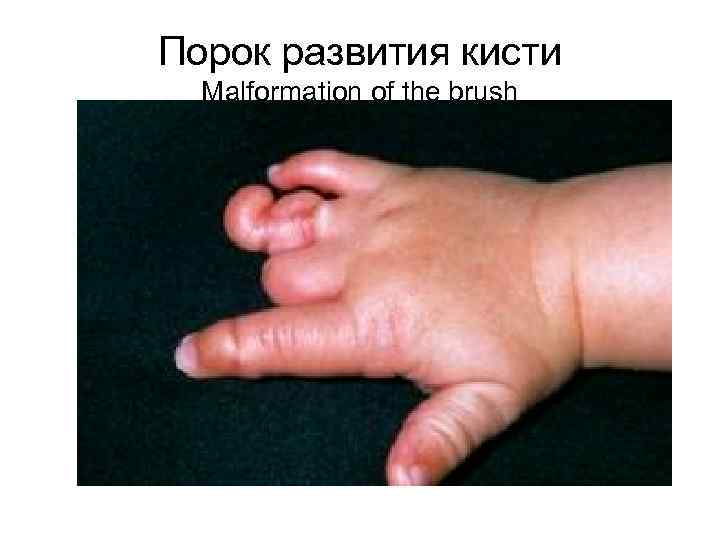 Порок развития кисти Malformation of the brush 