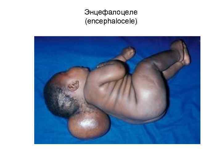 Энцефалоцеле (encephalocele) 