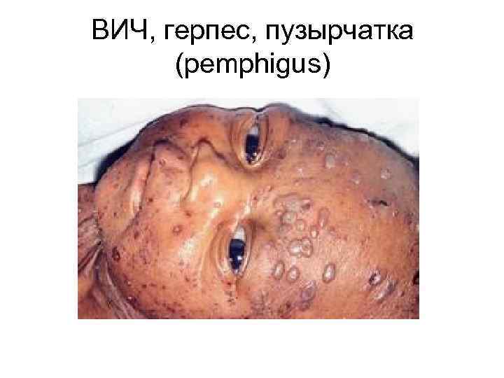 ВИЧ, герпес, пузырчатка (pemphigus) 