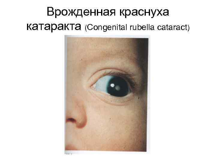 Врожденная краснуха катаракта (Congenital rubella cataract) 