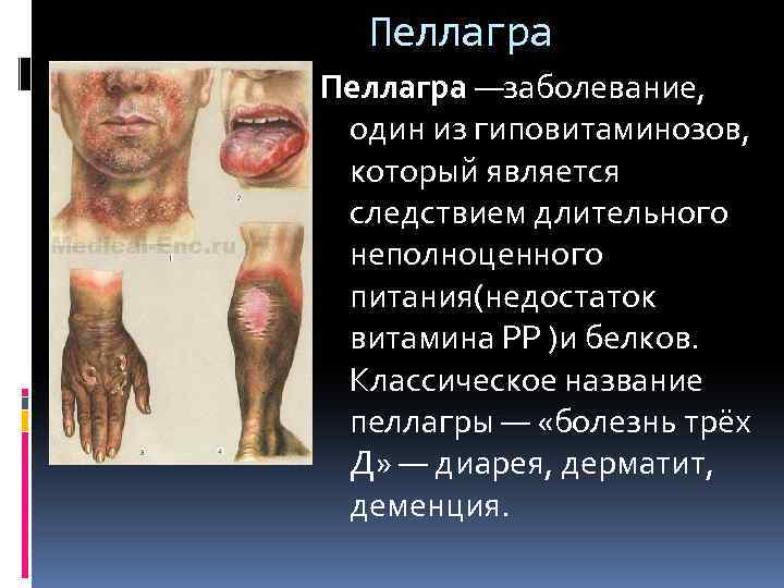 Пеллагра —заболевание, один из гиповитаминозов, который является следствием длительного неполноценного питания(недостаток витамина РР )и