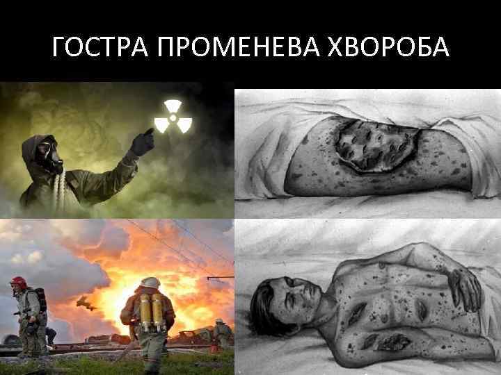 ГОСТРА ПРОМЕНЕВА ХВОРОБА 