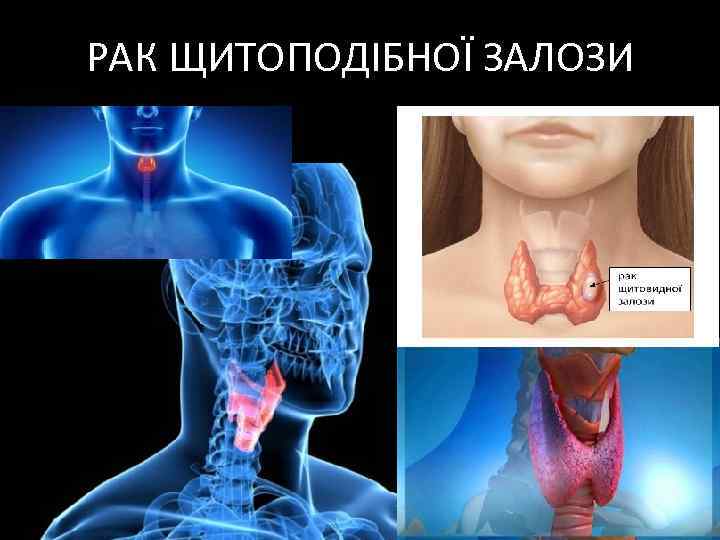 РАК ЩИТОПОДІБНОЇ ЗАЛОЗИ 
