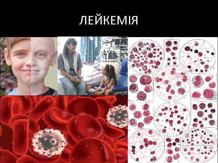 ЛЕЙКЕМІЯ 