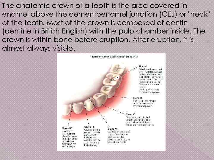 The anatomic crown of a tooth is the area covered in enamel above the