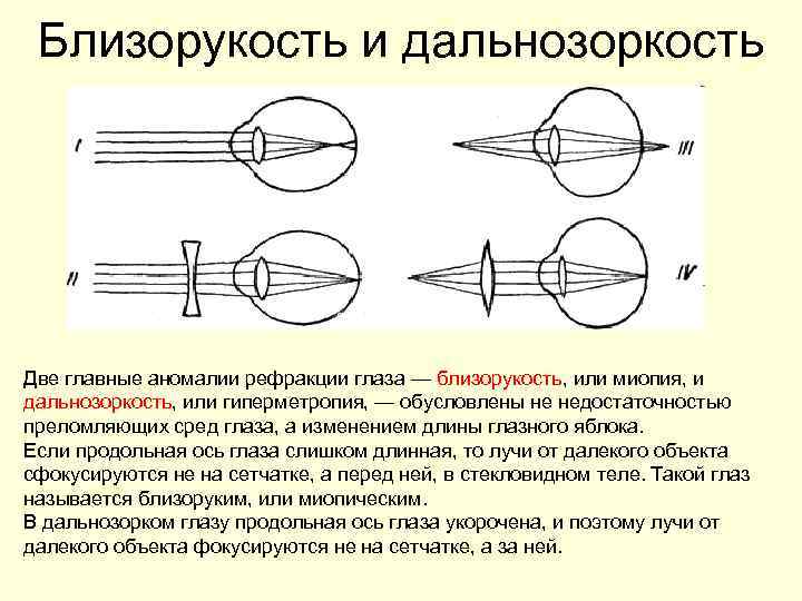 Близорукость и дальнозоркость Две главные аномалии рефракции глаза — близорукость, или миопия, и дальнозоркость,