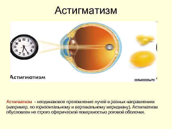 Астигматизм неодинаковое преломление лучей в разных направлениях (например, по горизонтальному и вертикальному меридиану). Астигматизм