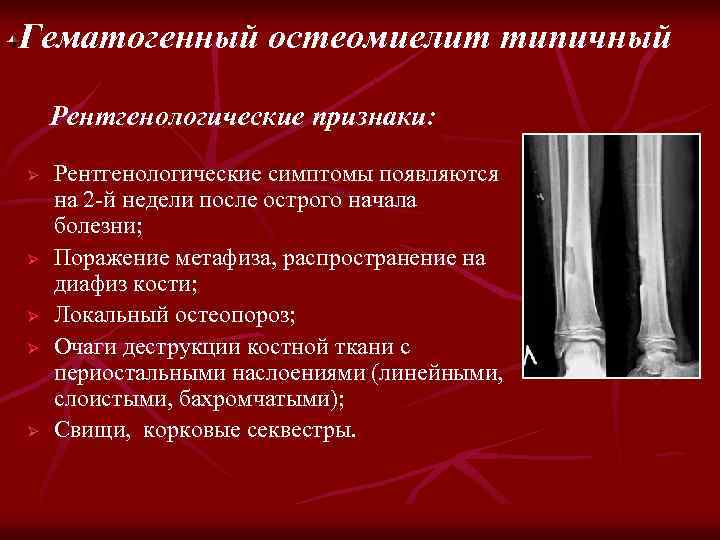 Гематогенный остеомиелит типичный Рентгенологические признаки: Ø Ø Ø Рентгенологические симптомы появляются на 2 -й