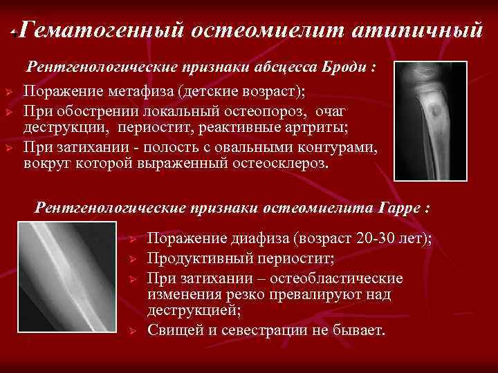 Гематогенный остеомиелит атипичный Ø Ø Ø Рентгенологические признаки абсцесса Броди : Поражение метафиза (детские