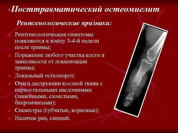 Рентгенодиагностика остеомиелита презентация