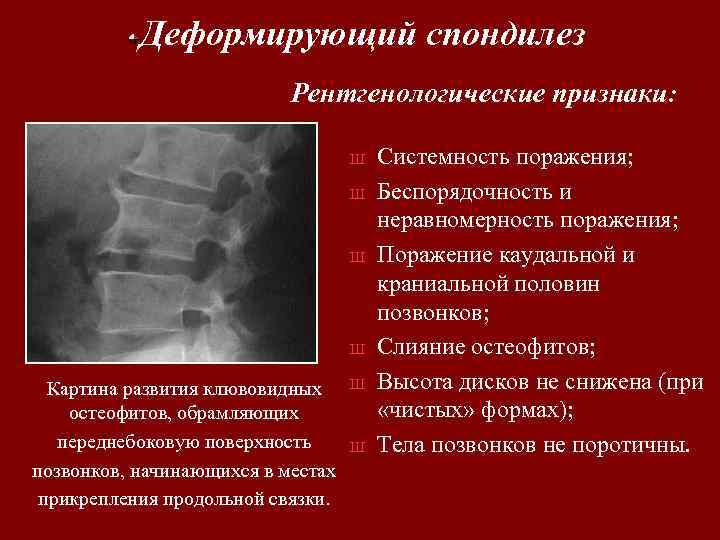 Спондилоартроз шейного отдела позвоночника. Деформирующий спондилёз рентгенодиагностика. Спондилез рентген. Деформирующий спондилоартроз рентген.