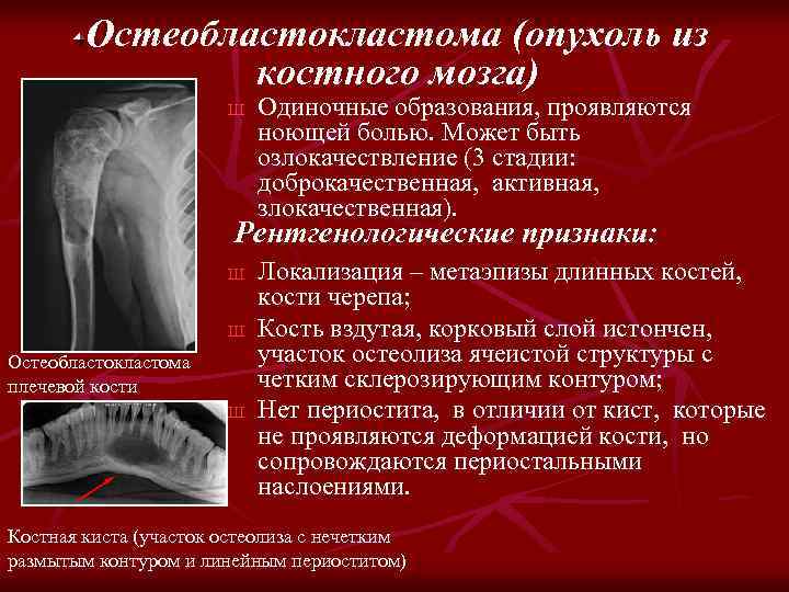 Остеобластокластома (опухоль из костного мозга) Ш Одиночные образования, проявляются ноющей болью. Может быть озлокачествление
